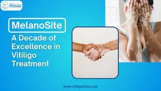 MelanoSite: A Decade of Transforming Lives with Expert Vitiligo Treatment
