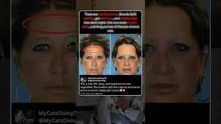 These are identical twins. Brenda (left) smoked, got more sun, and weighed less than Barb (right)