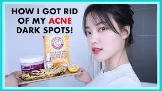 How to Fade Acne Dark Scars / Favorite Natural Home Remedies and Products