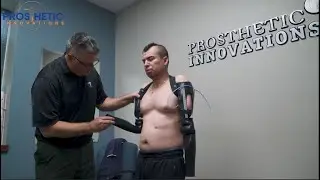 Bilateral Trans-Humeral Myo-Electric Elbow Placement | Prosthetic Innovations