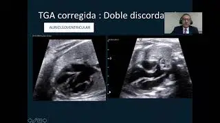 TRANSPOSICION CONGENITAMENTE CORREGIDA DE GRANDES ARTERIAS  (LTGA)            DR. MONTAÑO
