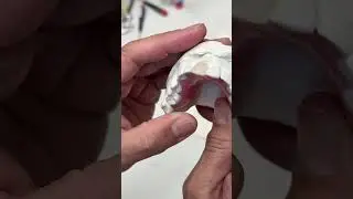 Amazing Acrylic Partial with no Clasps