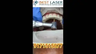 All on 4 neodent implants + ibar +printed resin prosthesis in upper jaw at affordable cost in India!