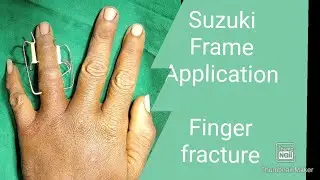 SUZUKI FRAME APPLICATION||FINGER FRACTURE|| PROXIMAL PHALYNX INTRAARTICULAR FRACTURE