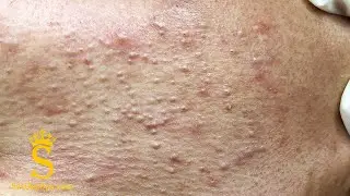 Pimples Around The Neck and Cheeks | Mụn Nổi Quanh Cổ V&agrave; M&aacute; - SacDepSpa#127