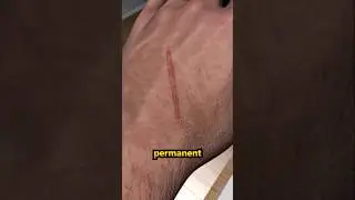 How Do Scars Form and Heal
