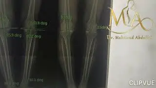 أهمية علاج تقوس الساقين مع دكتور محمود عبدالله