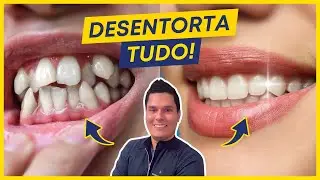 Dentes Tortos: Como Corrigir? (Os 2 principais m&eacute;todos)