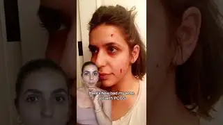 4 совета, как избавиться от прыщей при СПКЯ! #СПКЯ