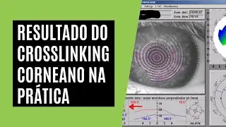 Resultado do Crosslinking Corneano na Pr&aacute;tica