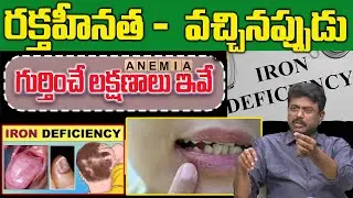 రక్తహీనత  లోపం యొక్క 11 విచిత్రమైన లక్షణాలు | Iron Deficiency | Dr Rajesh