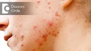 Difference between Inflammatory and Non Inflammatory Acne - Dr. Sudheendra Udbalker