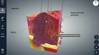 Reconstruction After Skin Cancer