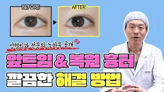 앞트임, 앞트임복원 후 흉터 사라지지 않고 있다면?