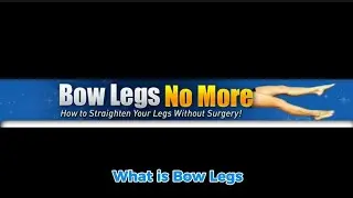 How to Fix Bow Legs & Knock Knees Naturally | Bow Legs No More&trade; Program