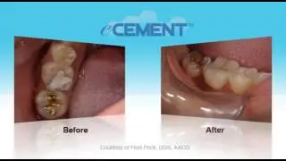 Optident - eCEMENT Universal Cementation