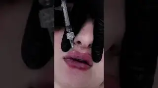 Preenchimento labial feito por Dr. Bruno Bergamasco