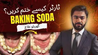 Best Home Remedy To Remove Tartar By Baking Soda | Tartar Khatam Karne Ka Gharelu Totka.