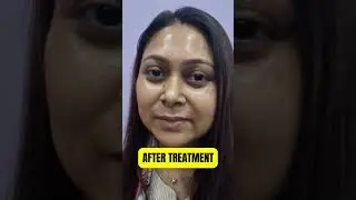 𝐀𝐝𝐯𝐚𝐧𝐜𝐞 𝐌𝐢𝐜𝐫𝐨𝐬𝐡𝐚𝐝𝐢𝐧𝐠 𝐄𝐲𝐞𝐛𝐫𝐨𝐰 𝐓𝐫𝐞𝐚𝐭𝐦𝐞𝐧𝐭-𝐆𝐥𝐚𝐬𝐬 𝐒𝐤𝐢𝐧 𝐓𝐫𝐞𝐚𝐭𝐦𝐞𝐧𝐭 𝐢𝐧 𝐊𝐨𝐥𝐤𝐚𝐭𝐚 #youtubereels #youtubeshorts