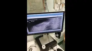 Quantock Hills / Triscombe MTB - Broken Collar Bone