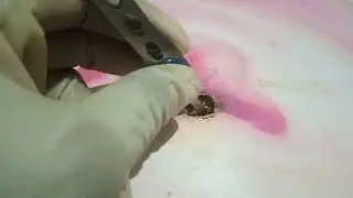 ASMR Ear cleansing - MASSIVE EAR WAX REMOVAL RESTORES HEARING AFTER 83 YEARS-----------