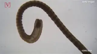 Doctors Discover Hundreds of Tapeworms in Man After He Eats Undercooked Pork