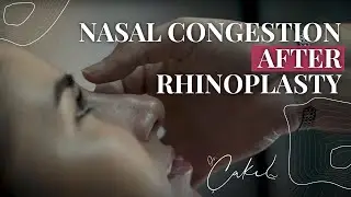 Nasal congestion after rhinoplasty - Dr Tolga &Ccedil;akıl