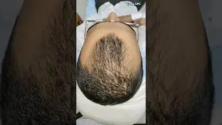 GFC therapy After 3 Session Result #doctor #trending #viral #hairloss #flowrichpharma #viyata #gfc
