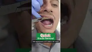 QUICK Braces Removal in 10 minutes: Dr. Srishti Bhatia #braces #cosmeticdentistry