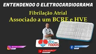 ECG - Fibrila&ccedil;&atilde;o Atrial associada &agrave; BCRE e HVE - Simulando TV