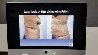 Paradoxical Adipose Hyperplasia (PAH) A Complication of CoolSculpting: how I treat them