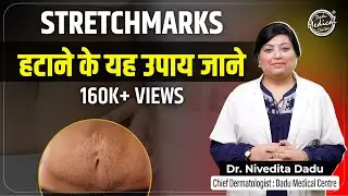 How to Remove Stretch Marks? (स्ट्रेच मार्क्स कैसे हटाएं?) | Best Stretch Mark Removal Creams | DMC