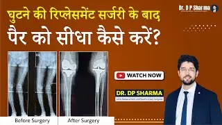How To Get Knee Straight After Knee Replacement Surgery? Bow Leg Correction in India- Dr DP Sharma