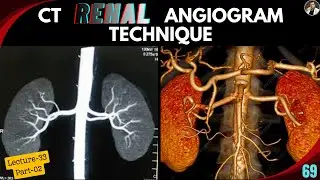 CT Renal Angiogram - Part-02 | Protocols | Post Processing | MIP | VRT | ROI set | Abnormal Cases |