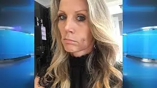 Surgery to Get Dimples?!