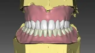 digitale Prothese