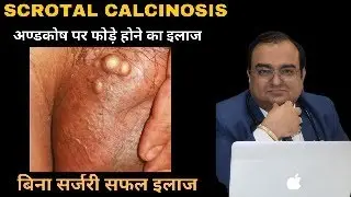 Scrotal Calcinosis Homeopathic Treatment | Medicines for Scrotal Cyst by Dr.Rajesh Sexology Centre