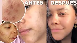 ELIMINAR MANCHAS (ROJAS, CAFÉ O MELASMA) + RUTINAS ✨ - MELI DE LA MORA