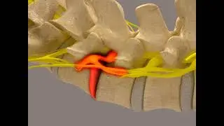 Spinal Decompression Prone