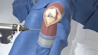 Total Knee Replacement in Virtual Reality