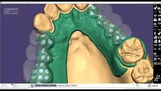 removible exocad