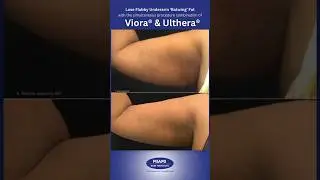 Firming Up Flabby Underarms with Ulthera and Viora