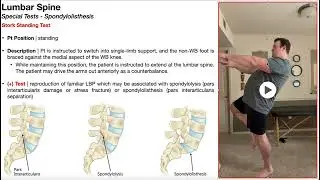 Stork Standing Test (for Spondylolisthesis) | Rationale & Interpretation