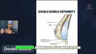 How to Avoid Double Bubble Deformity in Breast Augmentation