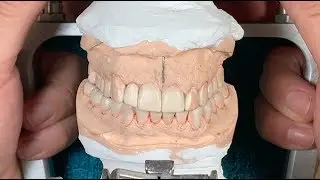Aumento de Dimensión Vertical Dental de Oclusión.