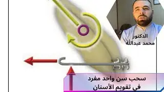 سحب سن مفرد اورثو