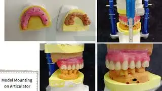 Segma Bridge + Scan Body