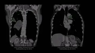 Recognizing Lung Cancer on CT Scans
