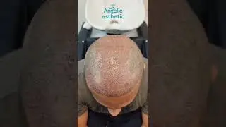 Hair transplant journey with Angelic esthetic....#Angelic_esthetic #hairtransplant #istanbul