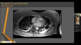 Cardiovascular Magnetic Resonance in Cardiac Iatrogenic Trauma - Leila Rezai Gharai, MD